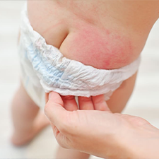 Diaper Rash