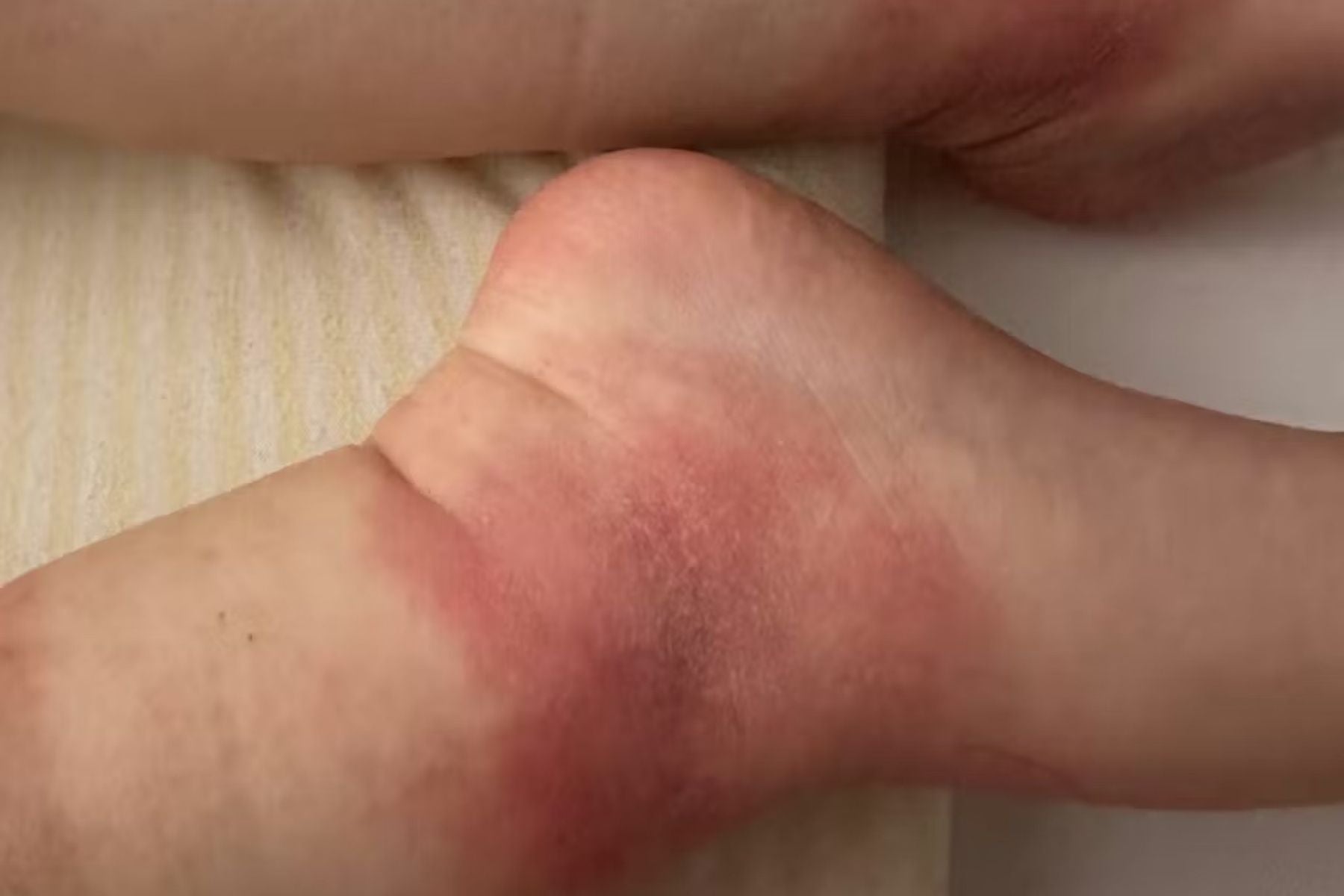 Red inflamed baby ankle with eczema rash on a white background