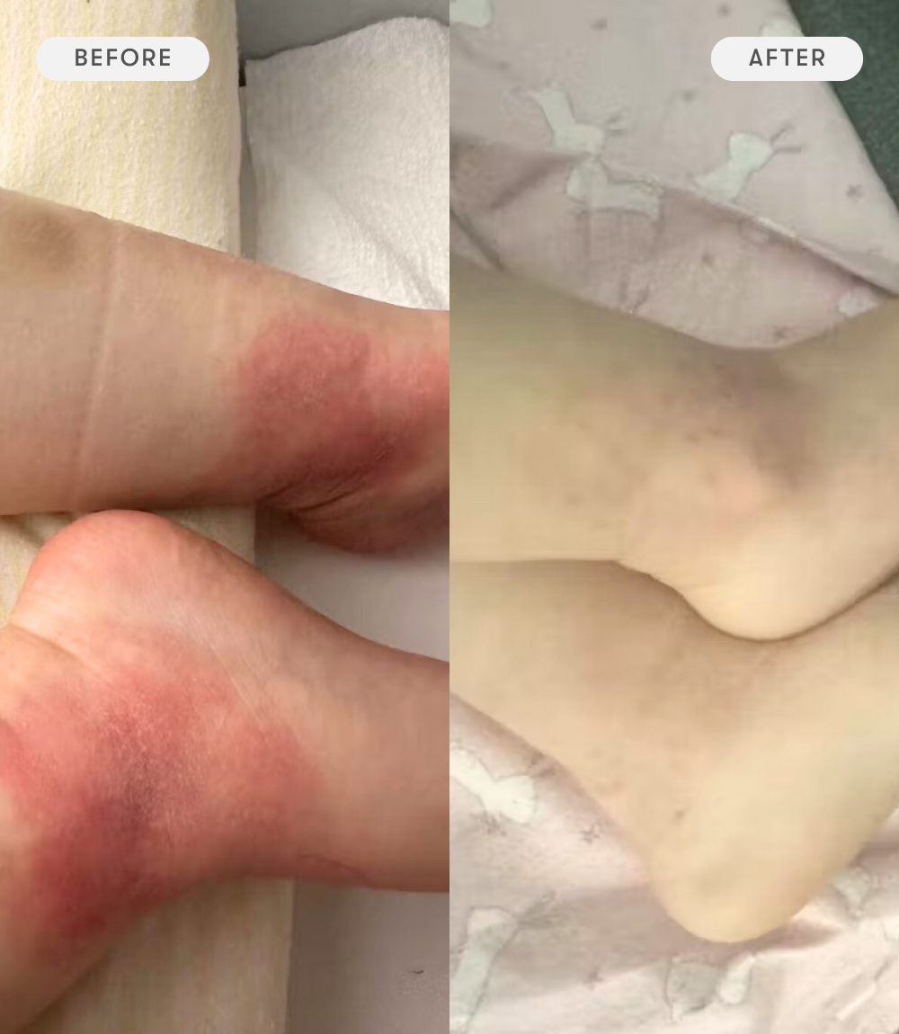 Before and after comparison of a child's ankles with redness skin condition on a soft fabric background.