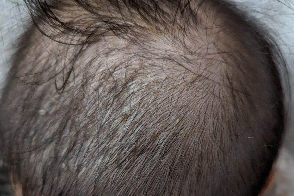 Close-up of a person's scalp with visible hair and skin texture. No more baby dandruff or cradle cap