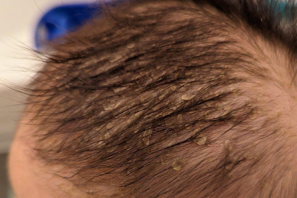 Close-up of a baby's scalp with visible baby dandruff or cradle cap