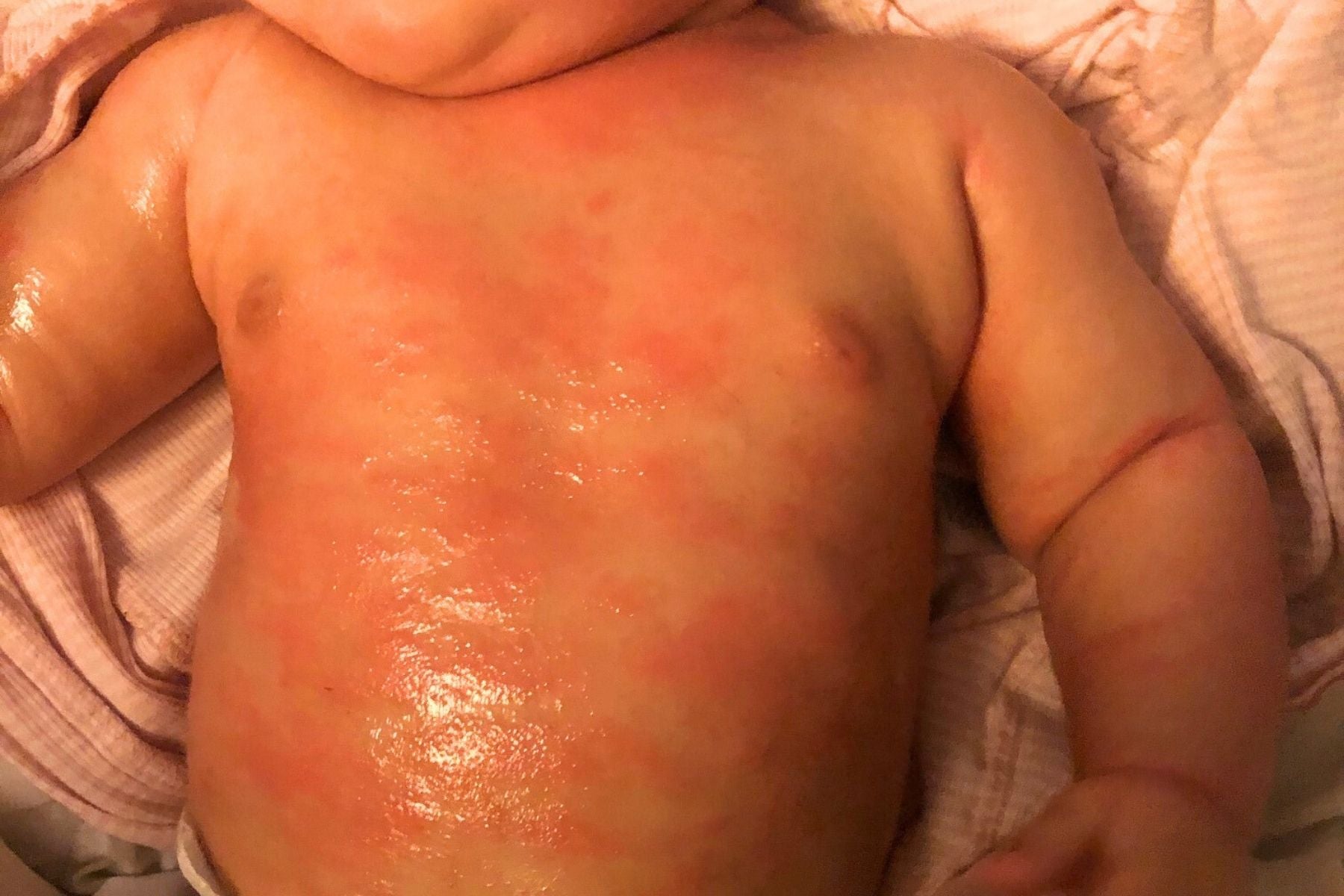 Baby with a red rash on its back