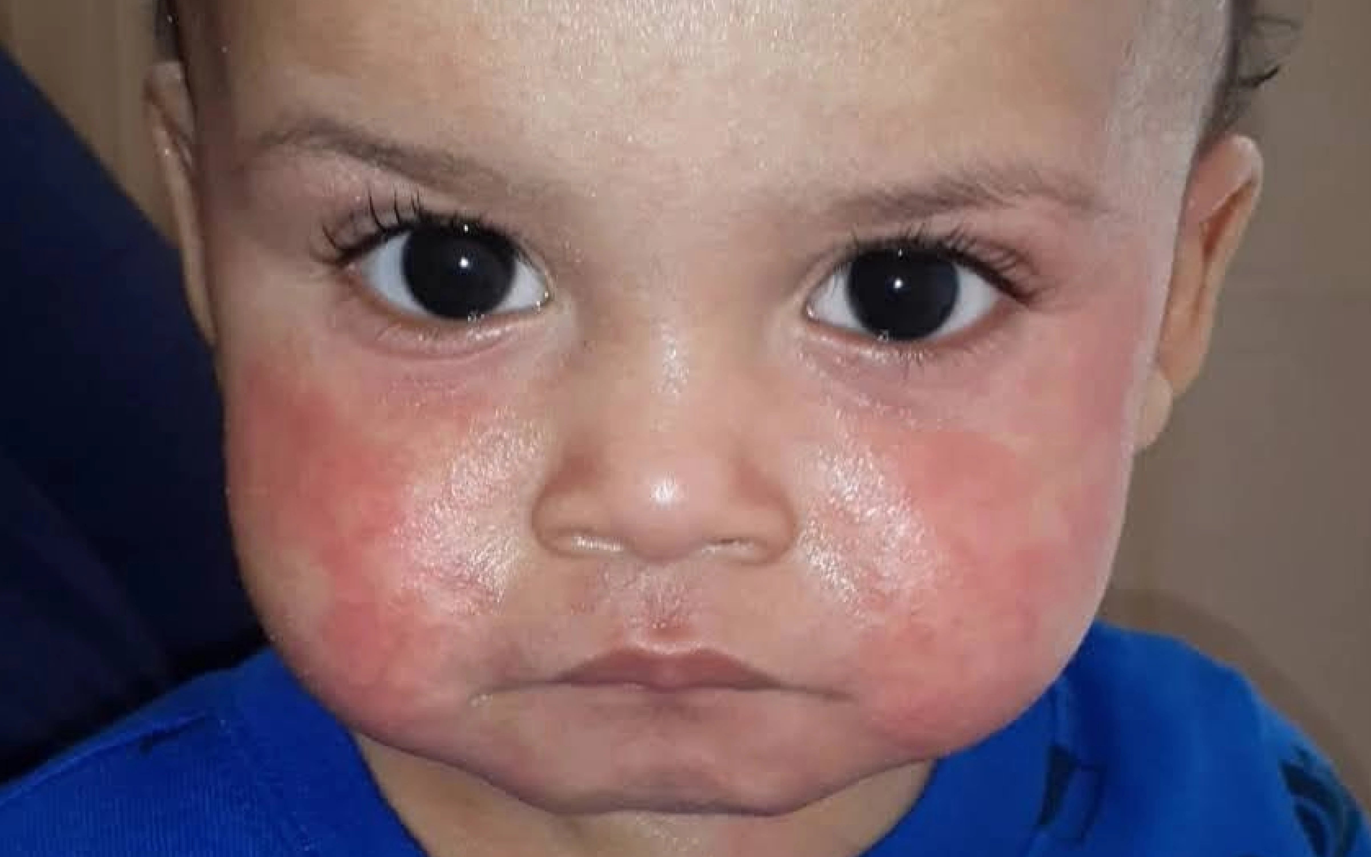 Baby with red rashy eczema cheeks wearing a blue shirt