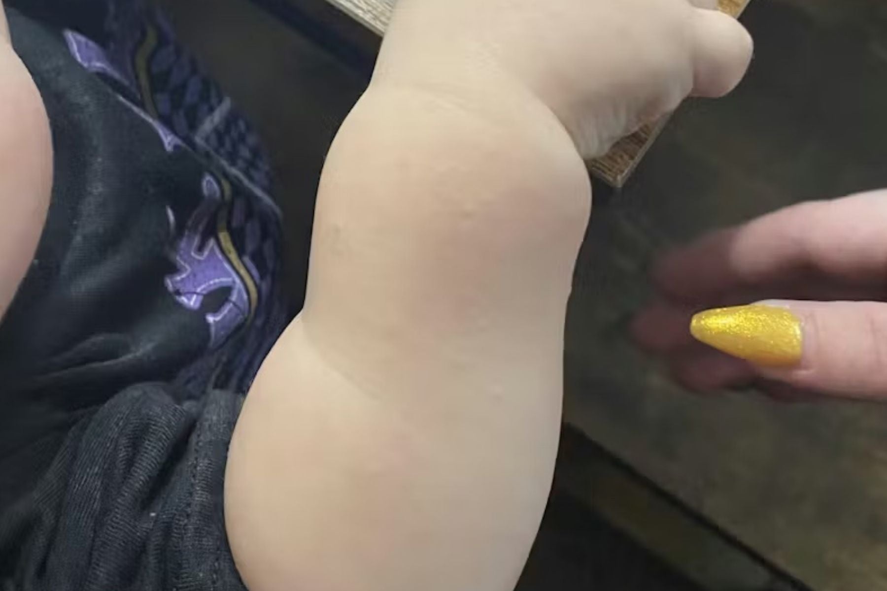 Close-up of a baby's arm with cleared skin bumps, potentially keratosis pilaris.