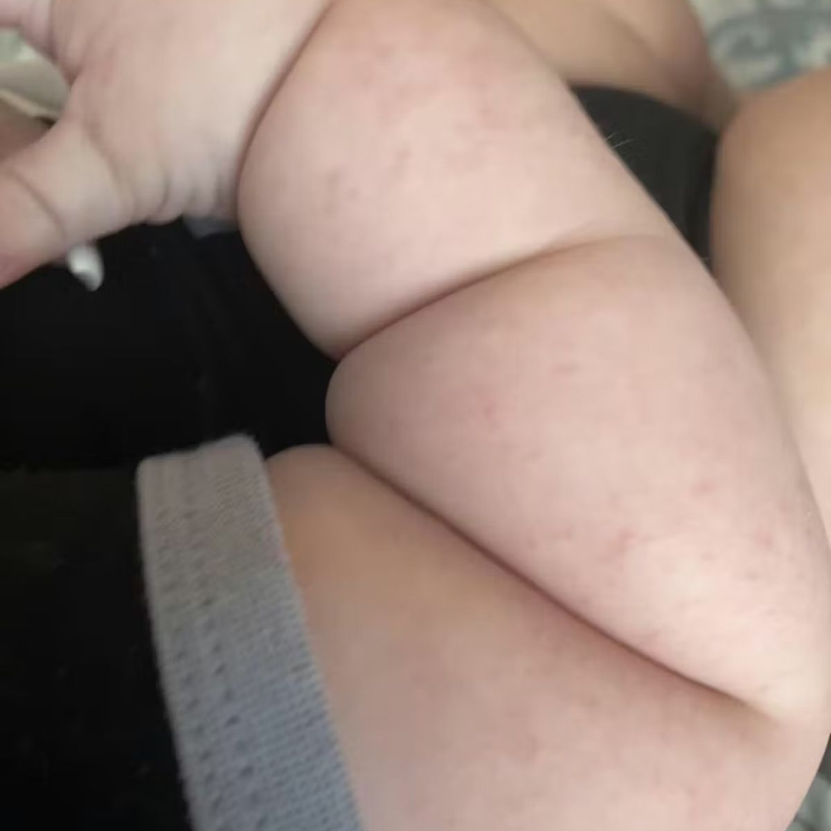 Close-up of a baby's arm with visible skin bumps, potentially keratosis pilaris.