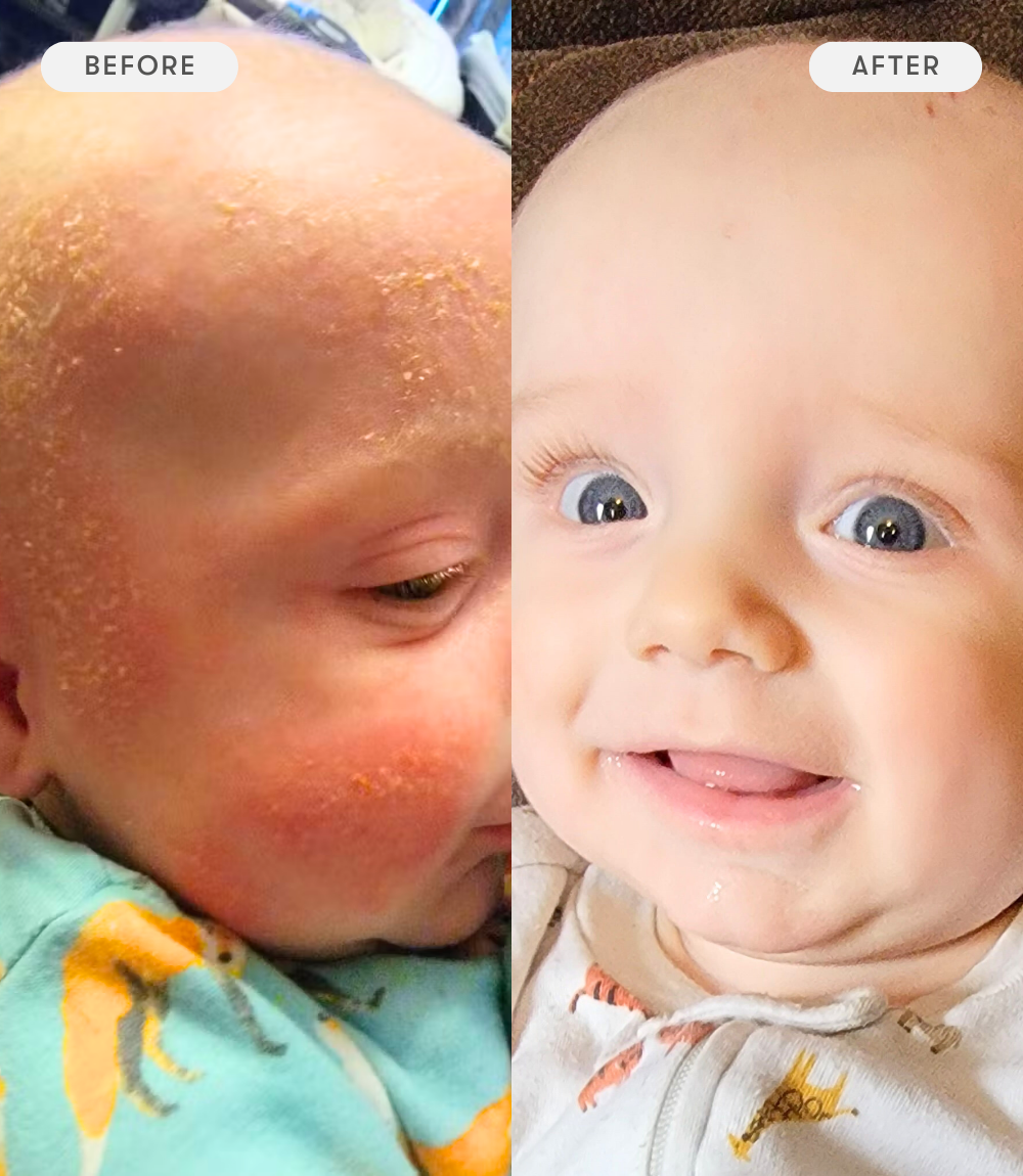 Before and after comparison of a baby's skin condition.