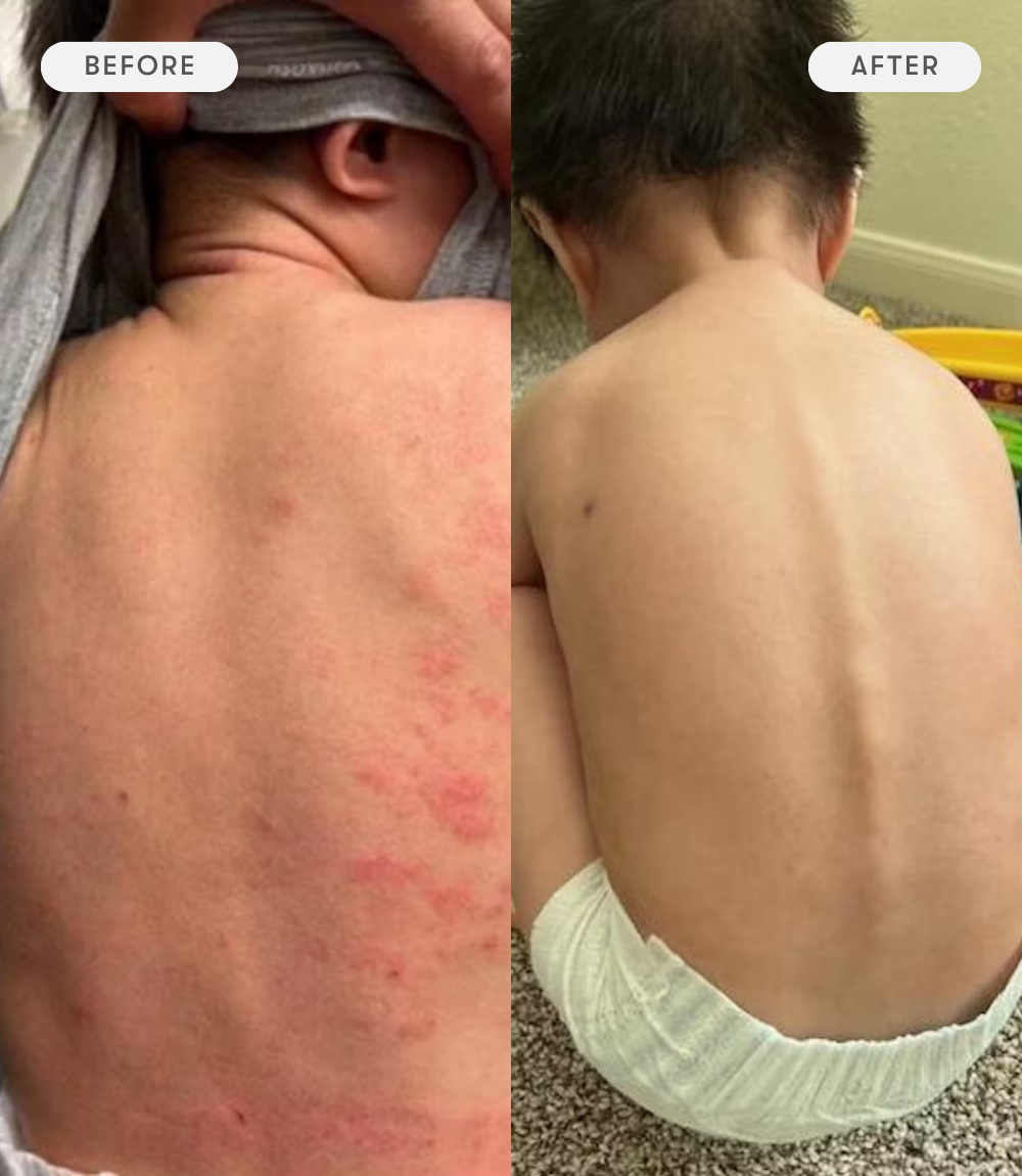 Before and after comparison of a child's back with visible skin conditions.
