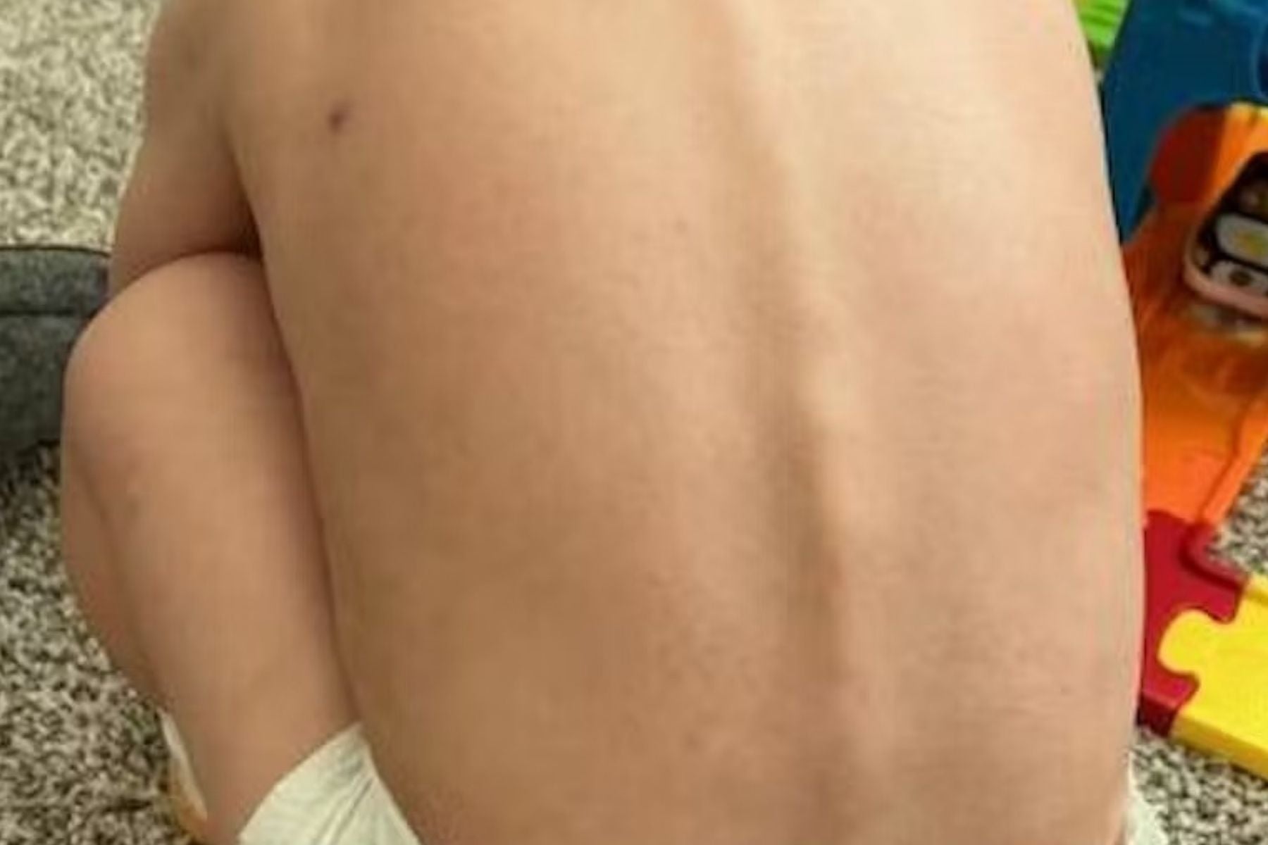 Boy's back with healed rashes sitting on the floor with colorful toys around