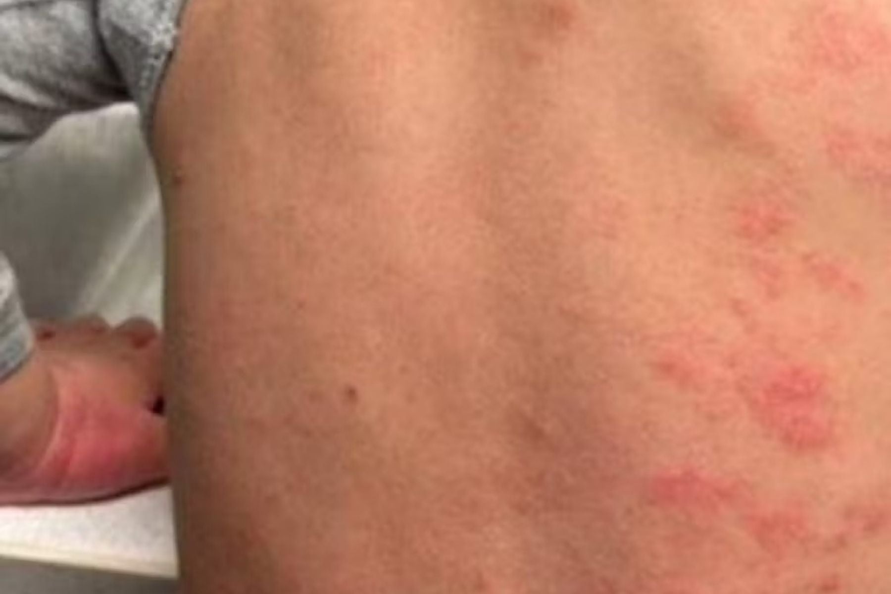 Boy's back with visible redness and bumps.