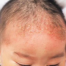 Cradle Cap