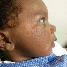 Baby Acne