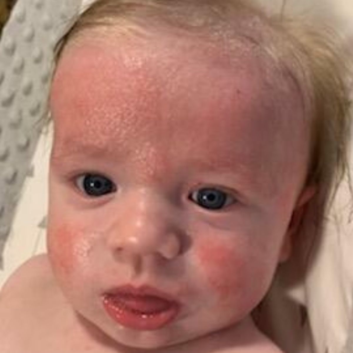Baby with a red eczema rash and cradle cap on face