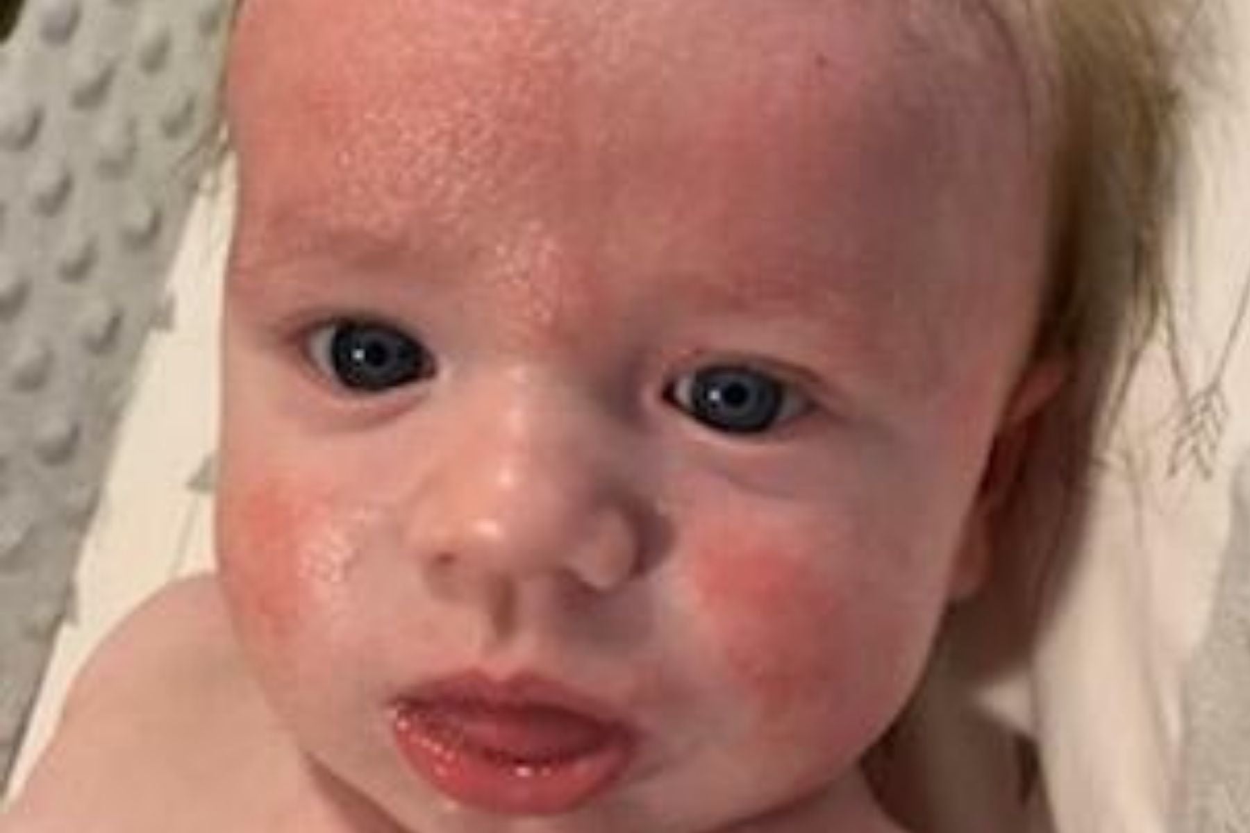 Baby with a red eczema rash and cradle cap on face