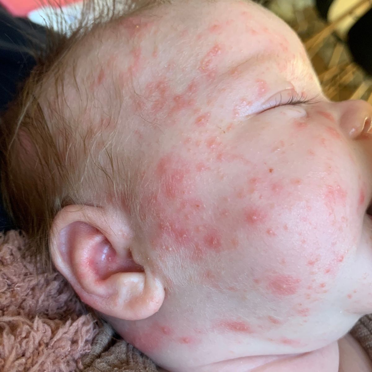 Close-up of a baby's face with redness and baby acne bumps on the skin.
