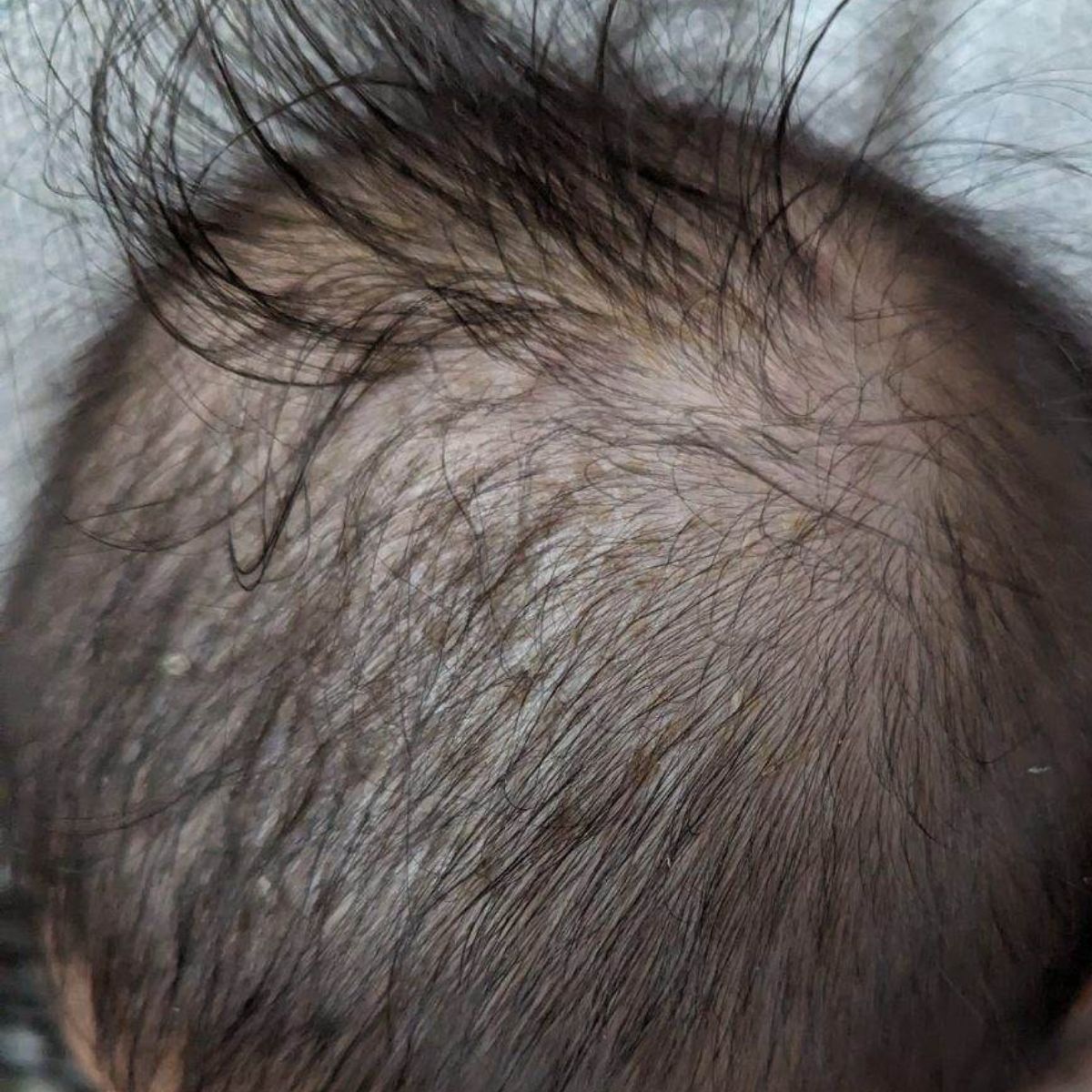 Close-up of a person's scalp with visible hair and skin texture. No more baby dandruff or cradle cap