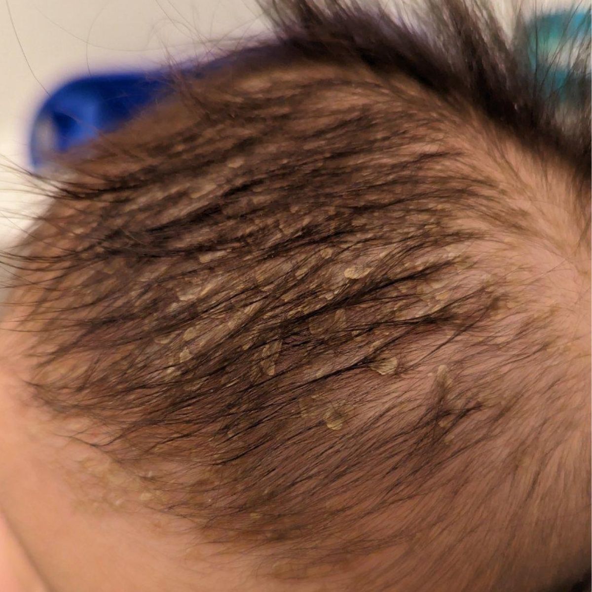 Close-up of a baby's scalp with visible baby dandruff or cradle cap