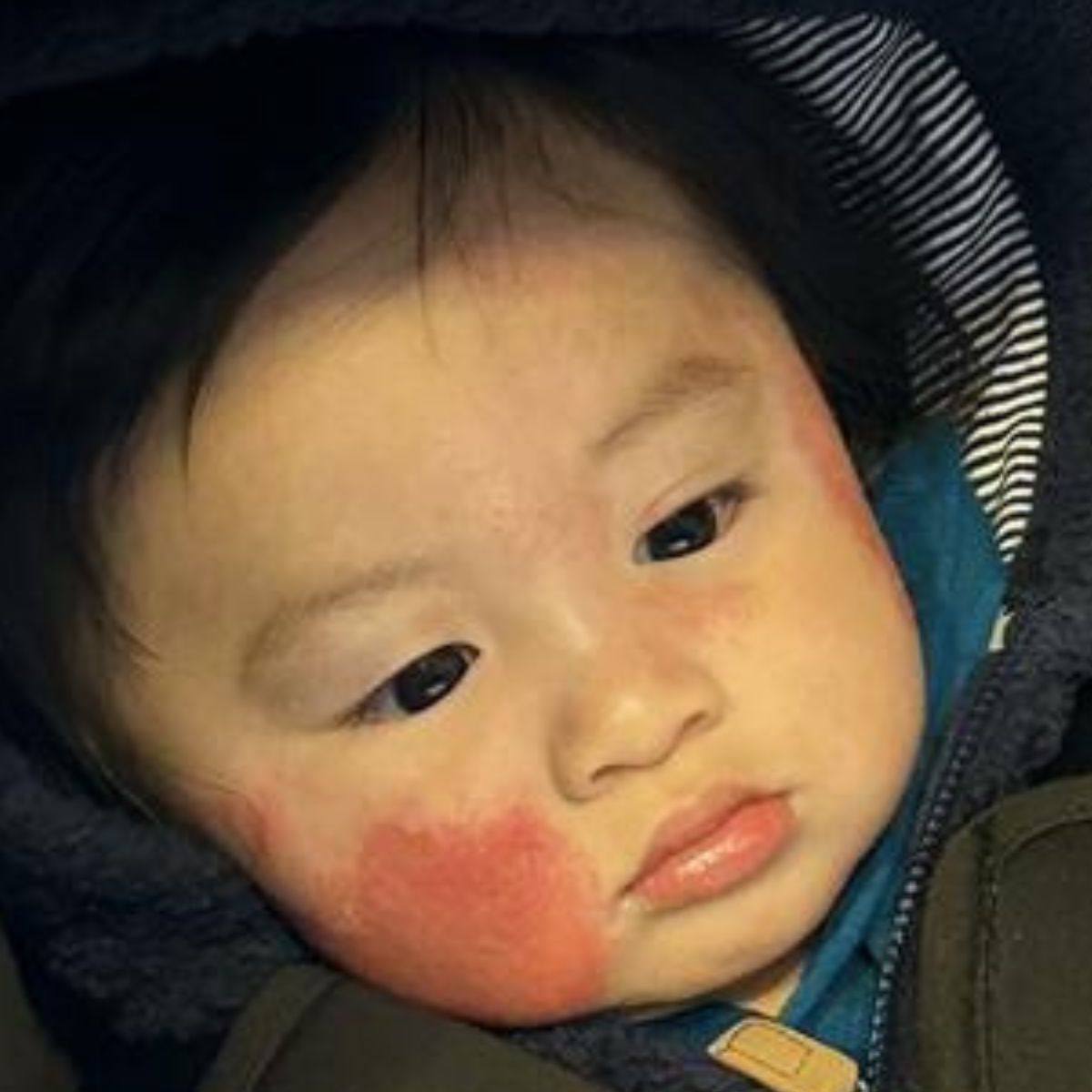 Child with a red rash, possibly due to cold weather or eczema, wearing a dark coat.