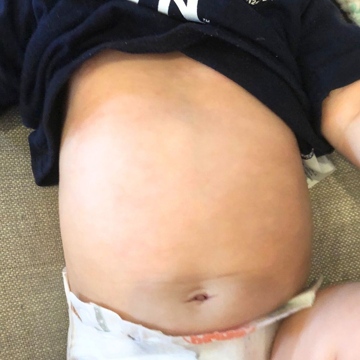 Close up of child's tummy with cleared eczema rash