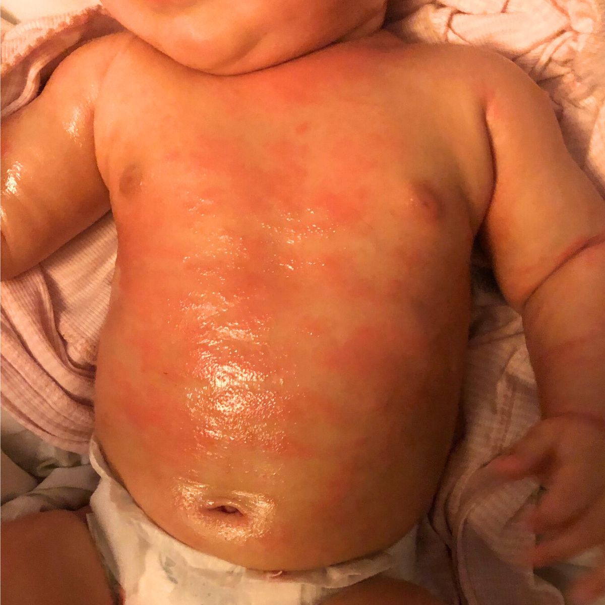 Close-up of a baby's skin with redness and rash