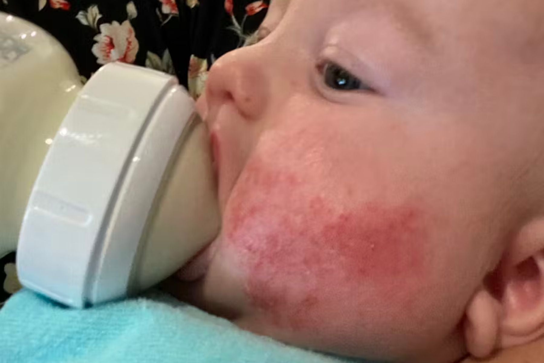 Baby with a red eczema rash on its face holding a bottle