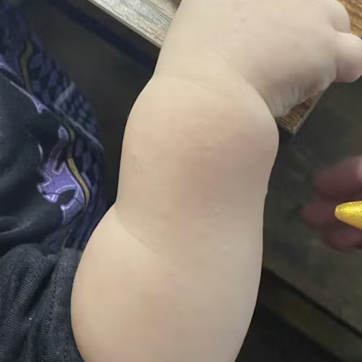 Close-up of a baby's arm with cleared skin bumps, potentially keratosis pilaris.